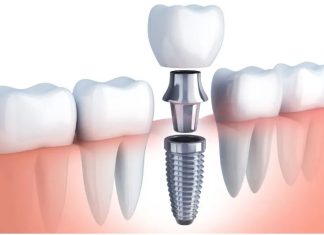 Tooth Extractions and Preservation: Ensuring Optimal Oral Health and Function
