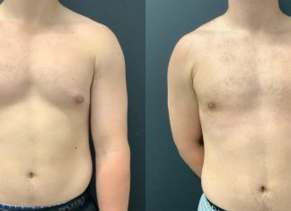 Maintaining Long-Term Results After Gynecomastia Surgery